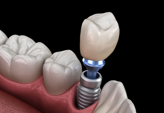Who Is A Good Candidate For Dental Implants