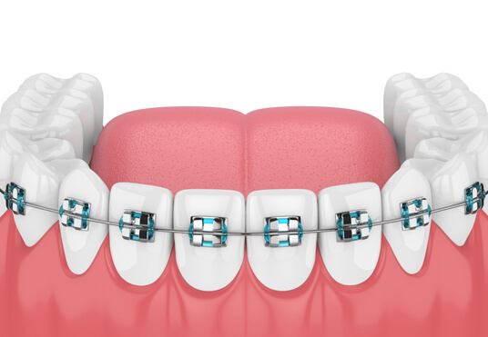 Why Is Orthodontic Treatment Needed