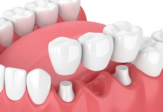 Why Might Dental Bridges Be Needed