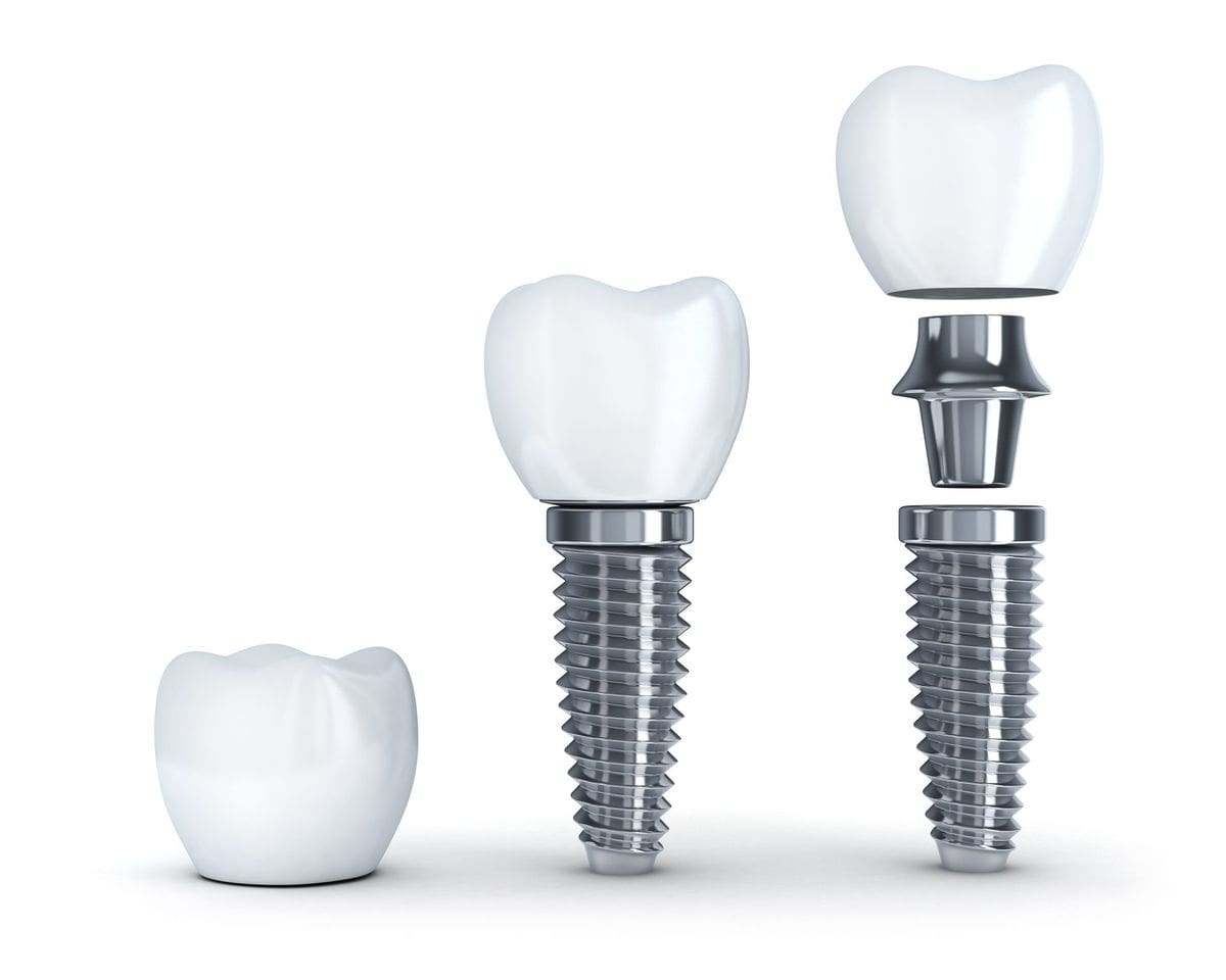 Client Series Of Implants