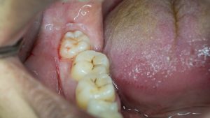 Pain In The Lower Wisdom Tooth