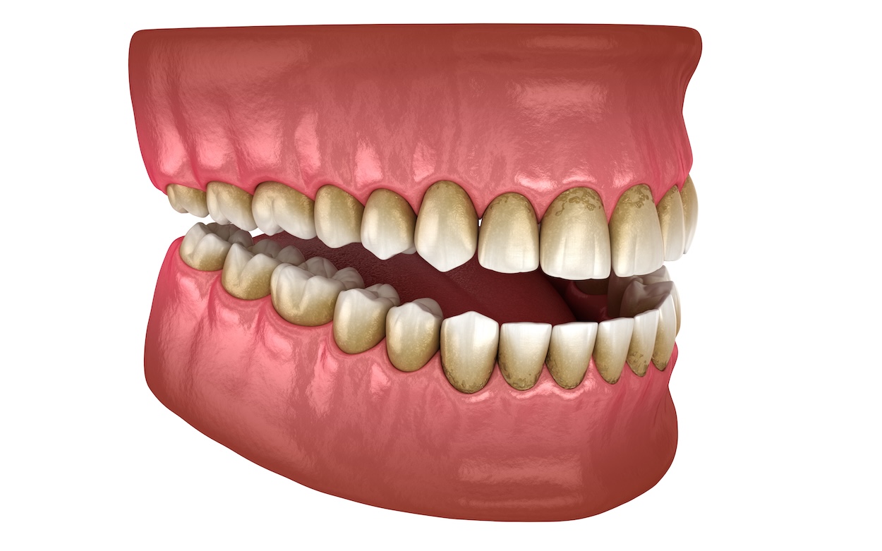 periodontal disease, gum disease, gingivitis, periodontitis, dental health, Hermitage Dental Group, symptoms of gum disease, causes of gum disease, stages of gum disease