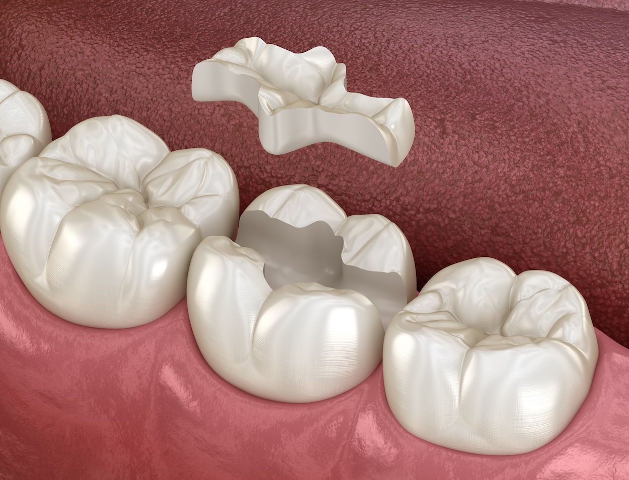 inlays and onlays, dental restorations, tooth repair, Hermitage Dental Group, Dr. Friedmann, Hermitage TN dentist, dental care, tooth decay treatment, durable dental solutions, smile restoration