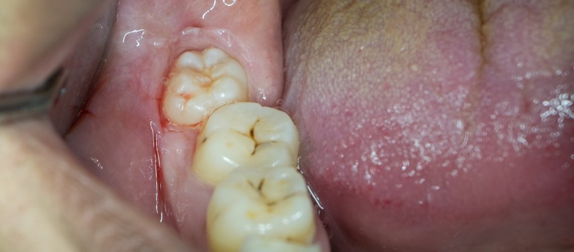Wisdom Teeth Removal | Awake or Asleep? | Best Dental in Houston, TX