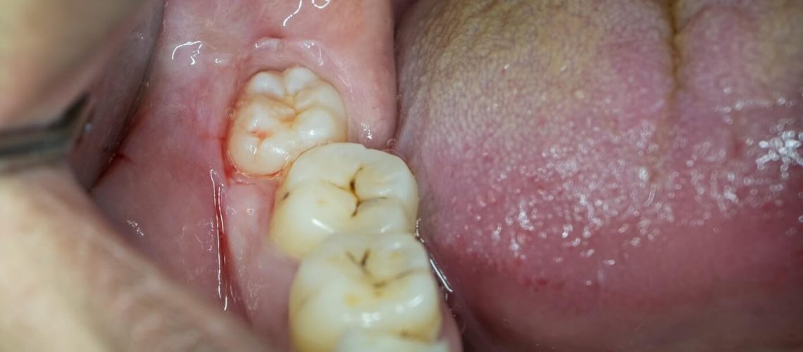 Pain In The Lower Wisdom Tooth